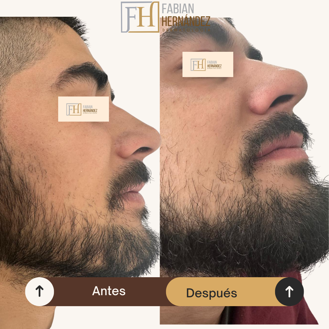Tratamiento de la alopecia de cejas, pestañas y barba